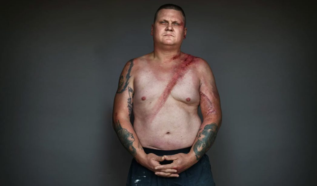 Las huellas del cinturón de seguridad tras un accidente: 10 casos reales